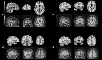 Unaltered Brain GABA Concentrations and Resting fMRI Activity in Functional Dyspepsia With and Without Comorbid Depression